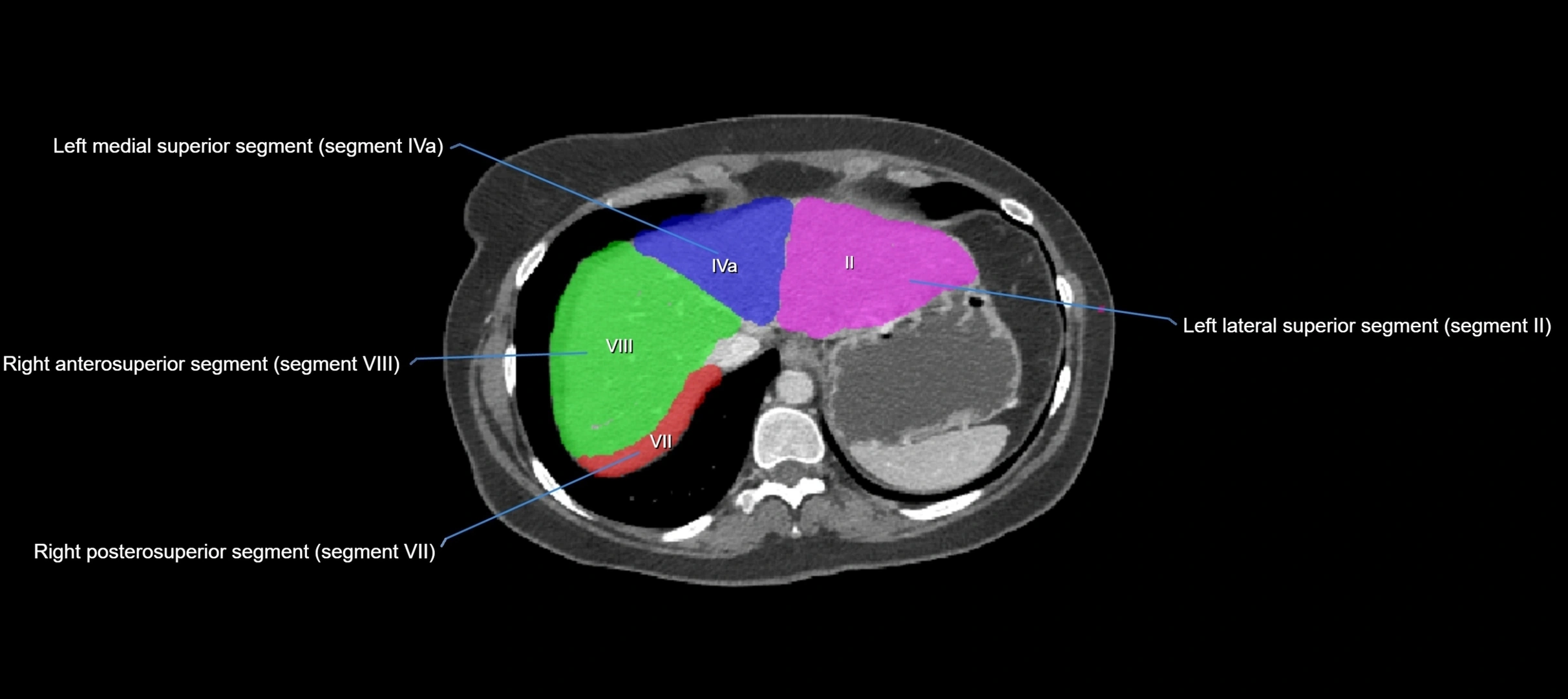 CT liver segments axial cross sectional anatomy labelled image-00067.webp